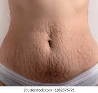 Post-Pregnancy Tummy to Arms: 7 Steps to Get Rid of Stretch Marks
